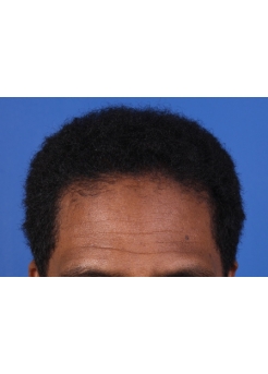 After Hair Transplant&nbsp;Front